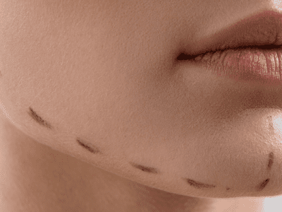 Çene Dolgusu (Jawline)