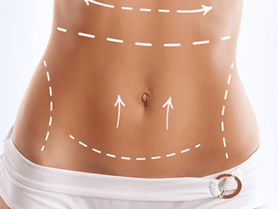 Karın Germe Ameliyatı (Abdominoplasty)