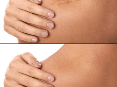 Leke ve Scar Tedavisi Üsküdar