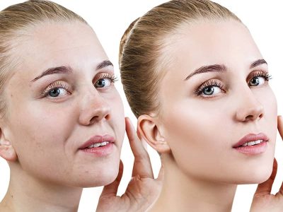 Baby Face Thulium Lazer Tedavisi Nişantaşı