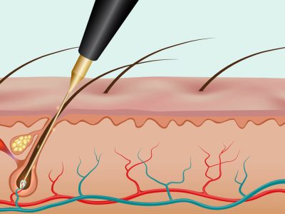 İğneli Epilasyon: Kalıcı Tüy Azaltmanın Etkili Yolu