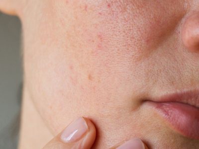 Cilt Lekelerinin Sebepleri ve Önleme Yolları