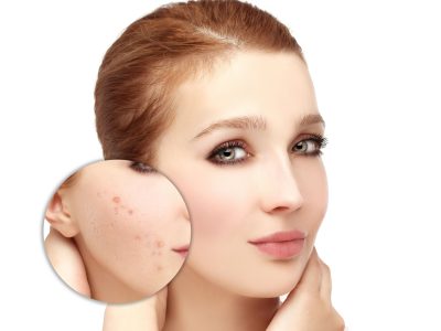 Cilt Lekesi Tedavisinde Nelere Dikkat Edilir?