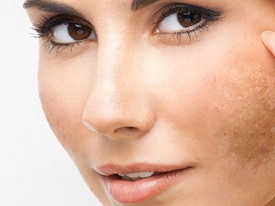 Güneş Lekeleri Hızlıca Nasıl Giderilir? Etkili Yöntemler ve İpuçları