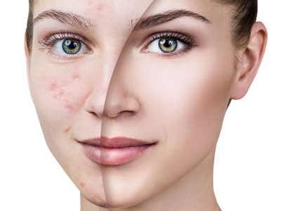 Hormonal Leke Problemi: Sebepleri, Belirtileri ve Tedavi Yöntemleri