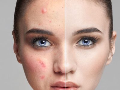 Nişantaşı Leke Tedavisi Rehberi: Koyu Lekelerden Kurtulmanın En Etkili Yöntemleri