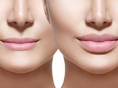 Dudak Dolgusu İstanbul Nişantaşı Hakkında Bilmeniz Gerekenler!