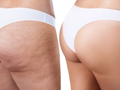 En Etkili Selülit Tedavisi Nedir?