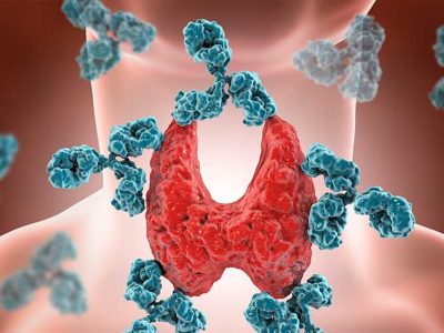 Hashimoto Hastalığı Nedir? Belirtileri ve Tedavi Yöntemleri