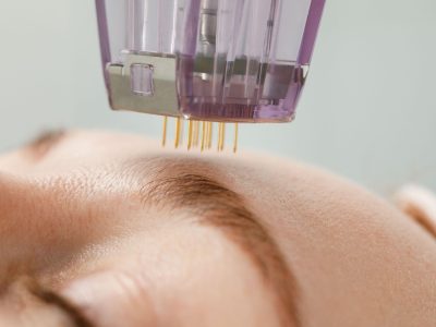 Üsküdar Altın İğne Tedavisi | 2026 Güncel Fiyatları